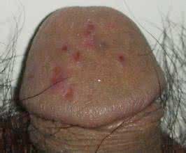 包皮过长治疗费用是多少